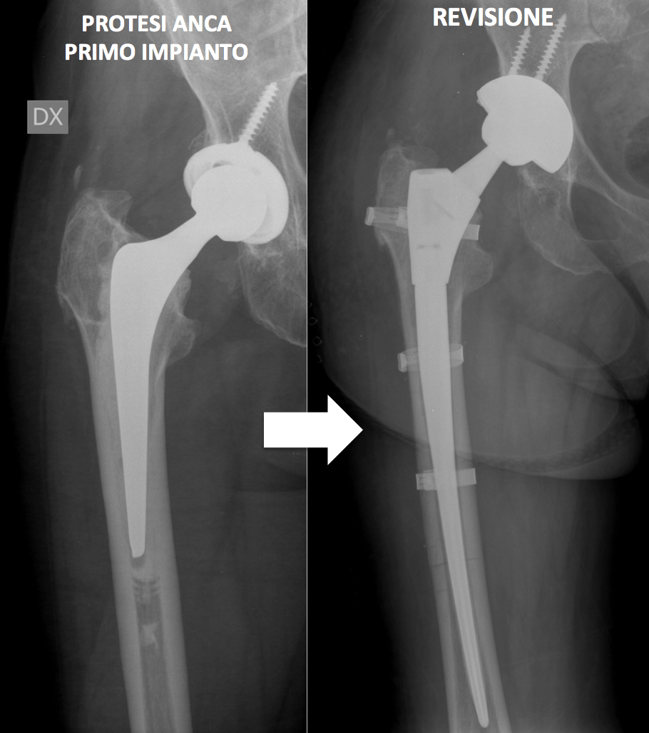 dolore muscolare allinguine dopo un intervento chirurgico di sostituzione dellanca